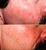 Лазерное удаление сосудов